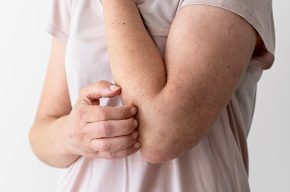 Mujer con la piel del brazo roja rascándose